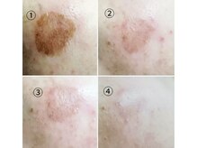 シェアキ(Chez Aki)/シミケアBefore/After