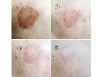 シェアキ(Chez Aki)/シミケアBefore/After