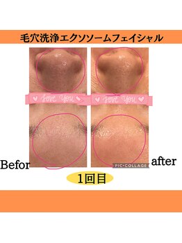 パルティノ 高崎店/毛穴洗浄・エクソソーム