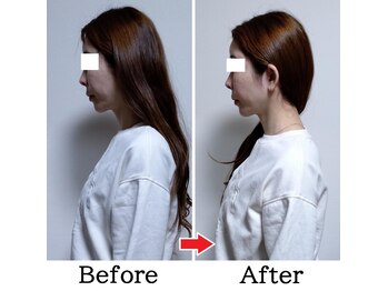 みなと/巻き肩・猫背矯正で小顔効果UP！