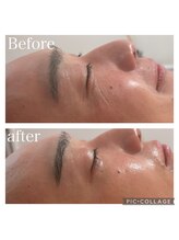 パールムーン(pearl moon)/水光肌フェイシャル/マーメイド