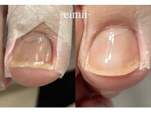 エイミー(eimii)/巻き爪ケア