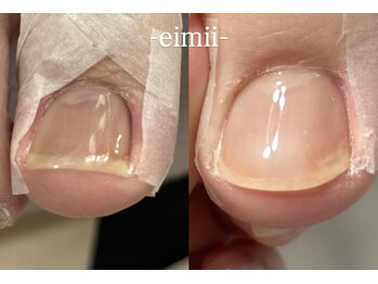 エイミー(eimii)/巻き爪ケア