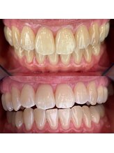 マイントゥー(mine too)/歯科医提携のホワイトニング！！