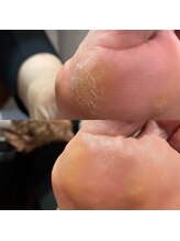 角質除去で硬い角質もツルツル