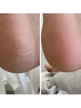 リチャーム(Recharm)の写真/ガサガサかかとを卒業！丁寧に角質を除去し、驚くほど「つるつる・もちもち」の素足へ導きます。