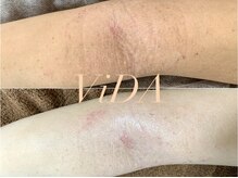 ヴィーダ 渋谷松濤(ViDA)/腕の肌質改善