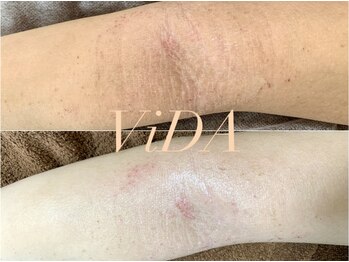 ヴィーダ 渋谷松濤(ViDA)/腕の肌質改善