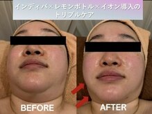 ラディアント(Radiant)/インディバ×レモンボトル