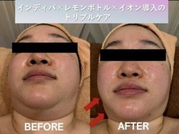 ラディアント(Radiant)/インディバ×レモンボトル