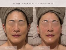 スイ(Sui)の雰囲気（ほうれい線が薄くなりすっきりした印象へ）