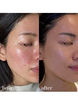 リアルナ(REALUNA)の写真/ハーブピーリングでニキビや毛穴・シミにアプローチ◎肌トラブル０のツヤ肌に♪[ハーブピーリング・関内]