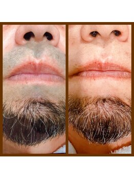 リアンジュ/ヒゲ脱毛の経過