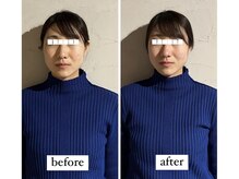マーマー(murmur.)/小顔矯正 before / after