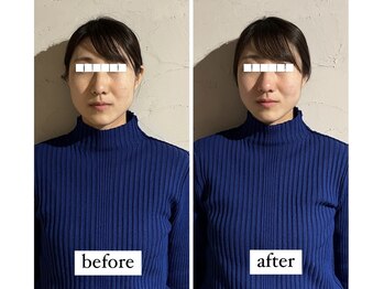 マーマー(murmur.)/小顔矯正 before / after