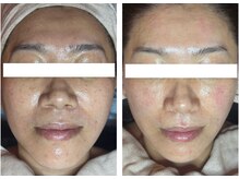 アマラ(Amarra)/迷ったらこれ！プラズマIPS