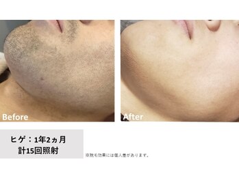 オントオフ(ON/off)/men's髭脱毛