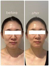 ラディアンス/小顔たるみ特化フェイシャル