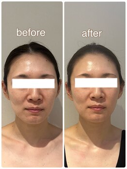 ラディアンス/小顔たるみ特化フェイシャル