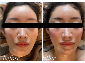 ビノスビューティー(vinos.beauty)/切らないフェイスリフト小顔矯正