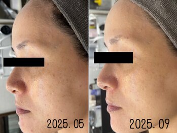 レイズ(RAISE)/当店人気No.1 水光ピーリング