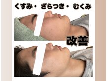 くすみ、もたつきもスッキリツルスベ◎ハーブピーリング