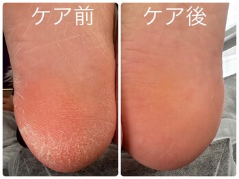 フォーチューン/足裏角質ケア♪