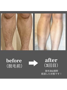 ブルーグロウ(Blue Glow)/脚脱毛ビフォーアフター