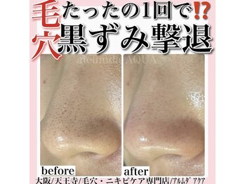 アルムダアクア 天王寺店(Aleumda AQUA)/毛穴エクストラクションプロ大阪