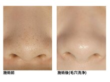 オーシャンブルー 佐世保店(OCEAN BLUE)/毛穴の黒ずみケア（毛穴洗浄）