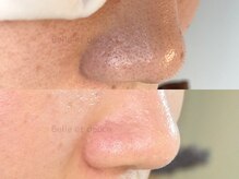 ベルエドゥース(Belle et Douce)/毛穴の黒ずみ症例