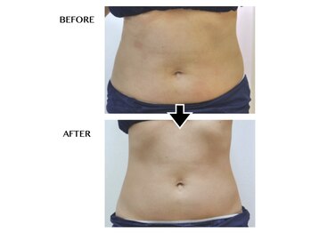 ウニ(uni)/【痩身】キャビ→ラジオ波→吸引