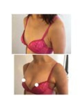 美人バスト 表参道店/【バストアップ/育乳 症例】