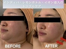 ラディアント(Radiant)/インディバ×レモンボトル