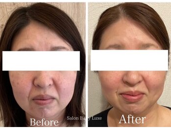 サロンベイビー 西宮本店(Salon Baby)/カッサでリフトアアップ