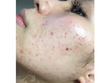 リベル 名古屋(Lebelle:)/ハーブピーリング専門名古屋