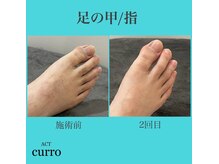 アクト クロ(ACT curro)/【足の甲・指】脱毛施術例