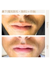 エスト(Est_.)/美容電気脱毛【鼻下】