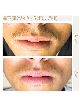 エスト(Est_.)/美容電気脱毛【鼻下】