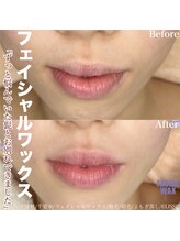 エリス(ELISSE)/悩んでいたヒゲとお別れできます