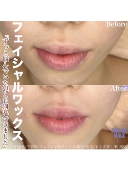 エリス(ELISSE)/悩んでいたヒゲとお別れできます