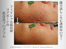 サロン ケイ(Salon K)/繰り返しニキビの気になる方へ