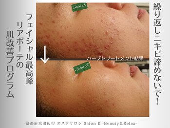 サロン ケイ(Salon K)/繰り返しニキビの気になる方へ