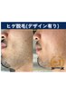 【メンズヒゲ脱毛】何回でも同じ価格(ヒゲデザイン有りの方)
