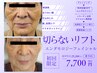 〈老けみえの原因はシワ？！〉目元の小ジワ、ほうれい線のシワ徹底