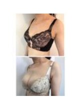 美人バスト 表参道店/【バストアップ/育乳 症例】