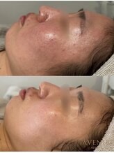 アベニール 芦屋/ニキビ/肌荒れ改善