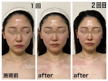 ダルセーニョ/産後のむくみ顔から美しい輪郭へ