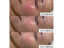 ルポ(RUPO)/赤み（20代）