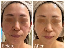 ロイヤル(ROYAL)/毛穴・ごわつき改善症例